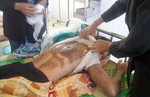 Đây là hình ảnh thương tâm trong một vụ bạo hành gia đình ở Cao Bằng. Chị L.T.T ở xã Đại Tiến, huyện Hòa An bị chồng  đổ xăng lên người đốt, gây bỏng nặng Ảnh: Thanh Hà